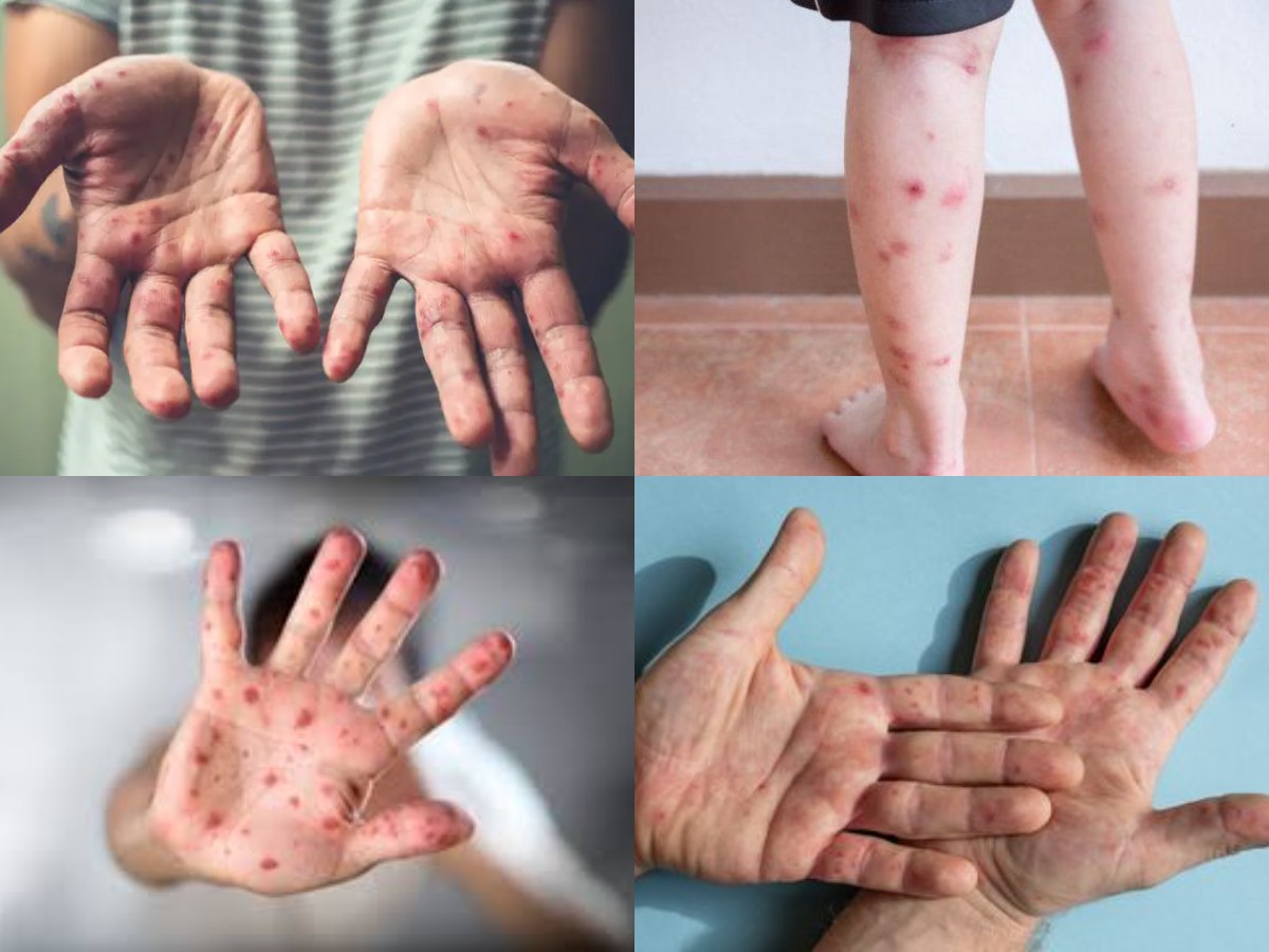 Flu Singapura tangan, kaki, dan mulut yang terdapat luka khas penyakit flu Singapura, untuk edukasi tentang gejala umum