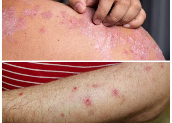 7 Tips Ampuh Mengatasi Darah Manis dan Memudarkan Bekas Luka agar Kulit Kembali Mulus