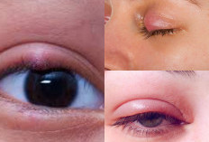 Jangan Takut, Berikut 4 Tips Metode Efektif Untuk Mengurangi Pembengkakan di Area Mata