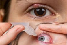 Bisa Sembuh dalam Semalam! Inilah 5 Tips Efektif Mengatasi Mata Bintitan Secara Alami dan Cepat di Rumah