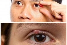Mata Bintitan Tak Kunjung Sembuh? Ini 5 Cara Alami yang Efektif dan Aman di Rumah