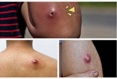 Bukan Dipencet, Cara Efektif Menangani Bisul yang Tak Kunjung Sembuh