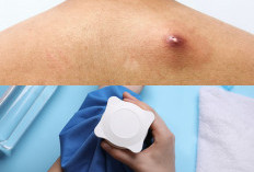 Cara Aman Atasi Bisul Hingga ke Akarnya: Rahasia Kulit Mulus Tanpa Bekas Luka