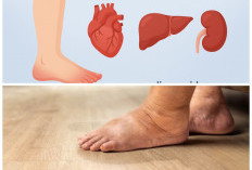 Kaki Sering Bengkak? Bisa Jadi Tanda Masalah Jantung, Ini Penyebab dan Penanganannya