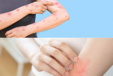 Sering Kambuh dan Bikin Gatal? Ini 5 Cara Efektif Mengatasi Darah Manis Agar Tak Ganggu Aktivitas