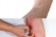 Kurap Mulai Membaik? Perhatikan 5 Tanda Penting Ini