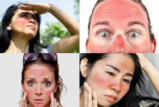 Tak Perlu Perawatan Mahal! 5 Tips Ampuh Mengatasi Wajah Terbakar Matahari Dengan Cepat
