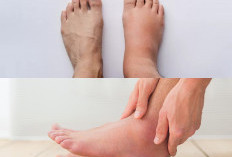 Intip 5 Penyebab Utama dan Cara Cepat Mengatasi Kaki Bengkak Tanpa Obat Kimia!