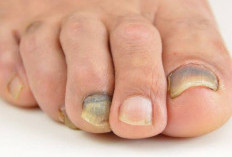 Ngeri! Ini Akibatnya Jika Kamu Malas Merawat Kuku Kaki!