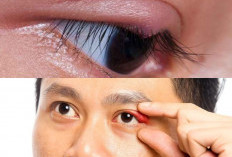 Tak Perlu ke Dokter, Inilah 5 Tips Efektif Mengatasi Mata Bintitan Dengan Cepat di Rumah!