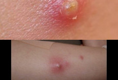 Bisul Jangan Dipencet! Dokter Ungkap Cara Ampuh Hilangkan Tanpa Bekas