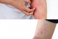 5 Tanda Kurap Mulai Sembuh, Plus Cara Mencegah Infeksi Datang Lagi