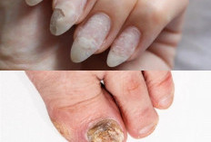7 Tips Ampuh Basmi Jamur Kuku Secara Alami: Rahasia Kuku Sehat dan Cantik Berkilau Kembali!