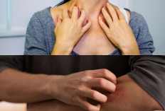 Kurap Sembuh Tanpa Kambuh: 5 Ciri dan Cara Pencegahannya