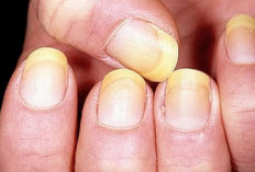 Kuku Tangan Kusam dan Kuning? Coba Trik Ampuh Ini Sebelum Tidur!