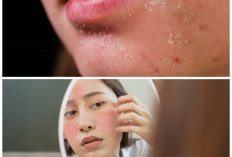 7 Cara Ampuh Mengatasi Kulit Wajah yang Mengelupas dan Kering, Bikin Kulit Lembap dan Sehat Kembali