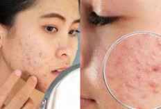 Rahasia Ampuh Mengatasi Jerawat Membandel: Tips Terbaru yang Jarang Diketahui, Wajah Bersih Bersinar!