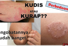 Ternyata Kudis, Kurap, dan Kutil Bisa Disembuhkan dengan Cara yang Berbeda, Begini Caranya!