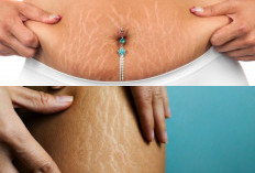 Rahasia Menghilangkan Stretch Mark Dengan Metode Yang Efektif Dan Aman