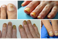 Ketahuilah, Penyebab dan Penanganannya Sindrom Kuku Kuning, Ini Penjelasannya! 