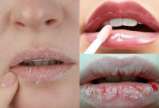 Mau Bibir Anda Sehat? Lakukan 5 Tips Ampuh Mengatasi Bibir Kering dan Pecah-Pecah