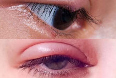 6 Langkah Sederhana Meredakan Kelopak Mata Terlipat Agar Kembali Segar dan Simetris!