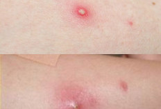 Jangan Sepelekan Bisul, Kenali Bahaya dan Penanganannya