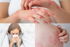 Kamu Alergi Dingin? Jangan Panik Ini 5 Cara Ampuh Menghadapi Alergi Dingin
