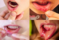 Jangan Cemas Sobat! Ini 5 Tips Sederhana Mengatasi Sariawan Panduan Harian Untuk Kesehatan Mulut Anda