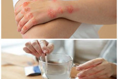 Tak Perlu Obat Mahal, 8 Bahan Alami di Dapur Ini Bisa Bantu Atasi Kurap dan Gatal Kulit