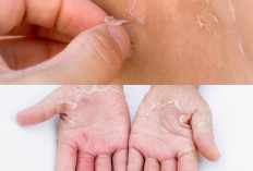 Kenali Penyebab Kulit Mengelupas dan Cara Mencegahnya agar Kulit Sehat