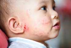 Obat Kimia Bisa Berbahaya! Ini 7 Cara Mengatasi Kudis Anak Tanpa Efek Samping yang Jarang Diketahui