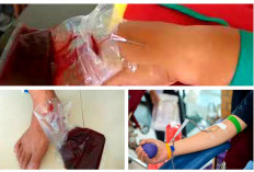 Mengenal Pengobatan Fasdhu dan Ini 6 Manfaat yang Didapat Untuk Kesehatan Tubuh