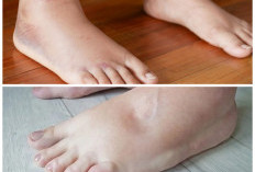 Waspadai Kaki Bengkak Akibat Gangguan Jantung, Kenali Gejala dan Cara Mengatasinya