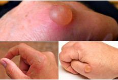 Tanpa Alasan Kulit Dapat Melepuh, Ternyata 6 Hal Ini Bisa Jadi Penyebabnya