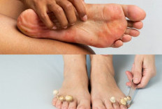 5 Tips Ampuh Mengatasi Jamur Kulit Kaki yang Membandel Secara Alami dan Medis