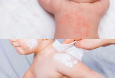 7 Tips Ampuh Mengatasi Biang Keringat Pada Bayi 2026: Cara Alami, Aman, dan Bikin Kulit Bayi Kembali Halus!