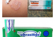 Rekomendasi 7 Obat Kurap Terbaik yang Mudah Ditemukan di Apotek