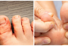 5 Cara Menghilangkan Kutu Air Secara Alami dan Medis