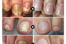 Ajaib! Kuku Kaki Bisa Kinclong Lagi Cuma Pakai 2 Bahan Alami Ini