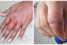 Ketahui! Ini 5 Cara Mengobati Jari Tangan Bengkak dan Sakit
