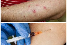 7 Cara Efektif Mengatasi Darah Manis dan Menghilangkan Bekas Luka yang Membandel