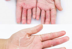 Kulit Mengelupas dan Gatal? Ini Bisa Jadi Dermatitis