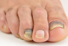Kuku Kaki Hitam dan Tebal? Begini Cara Mengatasinya Tanpa ke Klinik!