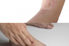 5 Ciri-Ciri Kurap Akan Sembuh dan Cara Mencegahnya Timbul Kembali, Jangan Sampai Kambuh!