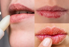 Bibir Kering: Begini 3 Tips Mengatasi Bibir Kering Dengan Bahan Rumahan