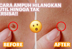 Rahasia Hilangkan Kutil Tanpa Obat! Cukup Pakai 2 Bahan Dapur Ini!