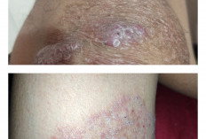 Darah Manis Bikin Kulit Gatal dan Luka Tak Kunjung Sembuh, Apa Penyebabnya?