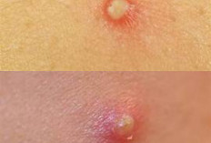 Bisul Tak Kunjung Sembuh? Ini Cara Mengatasinya agar Tidak Muncul Lagi