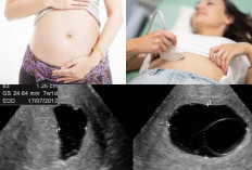 istilah hamil kosong atau tidak ada bayi dalam rahimnya (Blighted Ovum)
